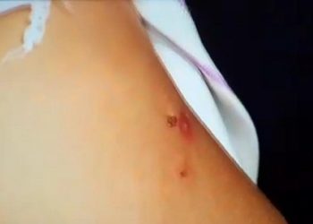 Madrasta é suspeita de queimar enteada de 6 anos com cigarro na Grande Natal. Polícia Civil investiga caso