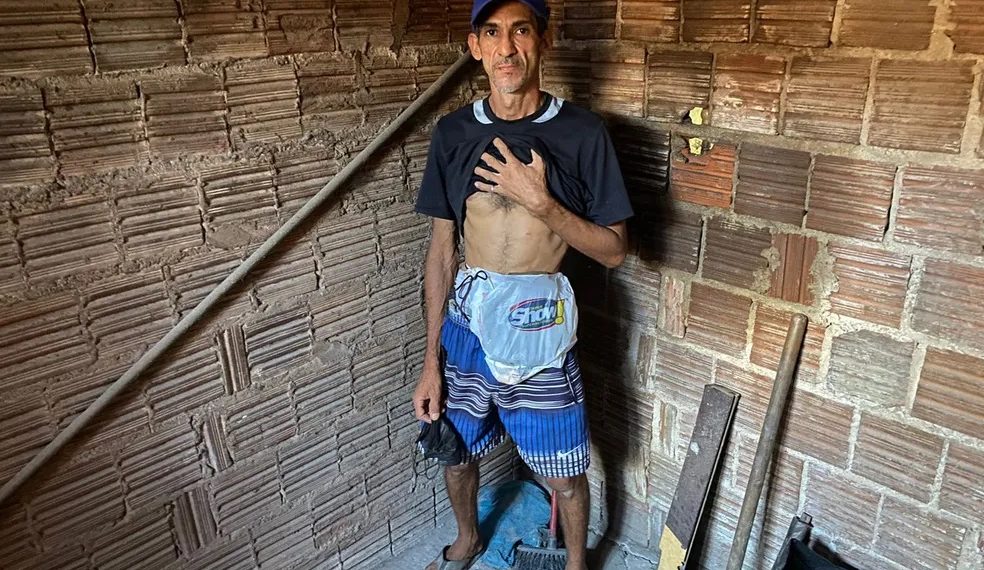 Paciente de Natal que improvisava sacola no lugar de bolsa de colostomia não está em fila para cirurgia por erro do município, diz Sesap-RN
