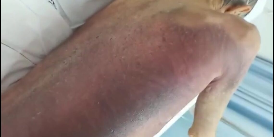 Idoso está há 23 dias com hemorragia e aguardando atendimento na UPA Potengi