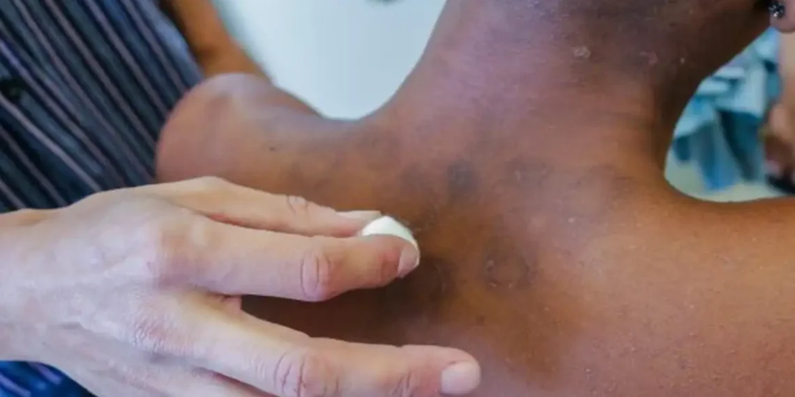 Novos casos de hanseníase aumentaram 5% de janeiro a novembro de 2023