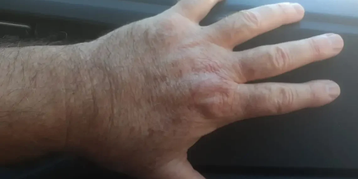 Fiocruz: estudo reduz riscos do tratamento contra leishmaniose cutânea