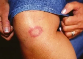 Hanseníase: conheça verdades e mitos sobre a doença