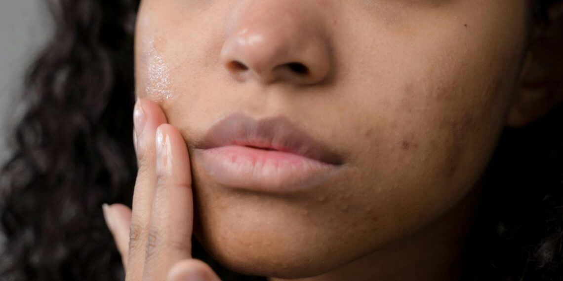 A pele, no mesmo tom – UFRN busca patentear formulação cosmética com ação despigmentante, hidratante e rejuvenescedora