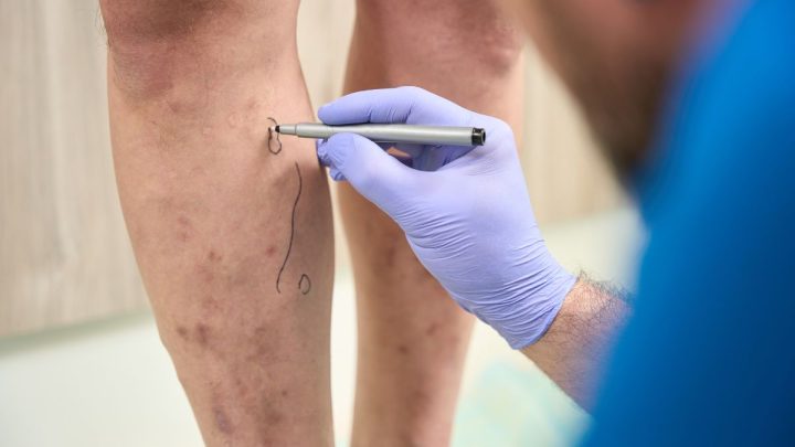 Varizes calibrosas exigem diagnóstico preciso e tratamento especializado