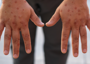 Natal reforça cuidados após primeiro caso de Mpox de 2026