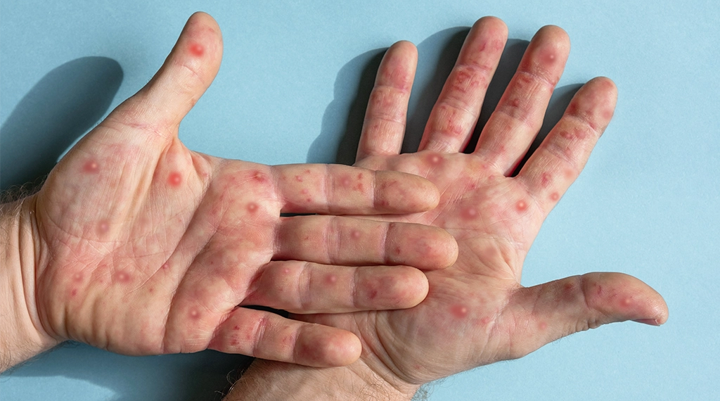 RN registra primeiros casos de monkeypox em 2026