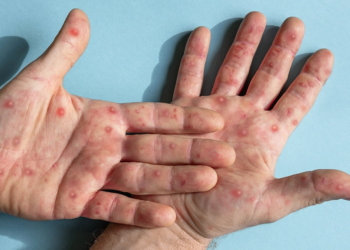 RN registra primeiros casos de monkeypox em 2026