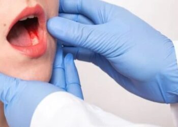 Mucosite Oral: como minimizar os impactos no tratamento do câncer