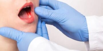 Mucosite Oral: como minimizar os impactos no tratamento do câncer