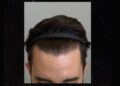 Transplante capilar: por que a linha frontal “perfeita” pode não ser a mais adequada para cada rosto?