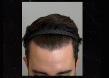 Transplante capilar: por que a linha frontal “perfeita” pode não ser a mais adequada para cada rosto?